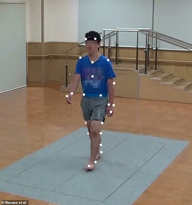 Breakthrough Discovery: 'Duck-Like' Backside Identified as Potential Biomarker for Autism and ADHD in Children