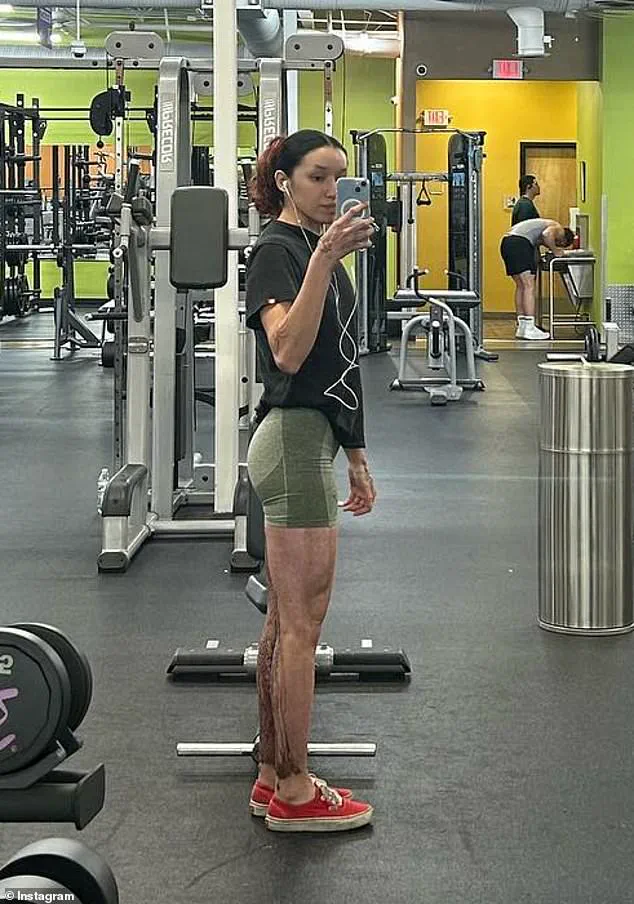 Breaking: Davina Licon's Acid Attack Survival Battle Intensifies After Five Surgeries