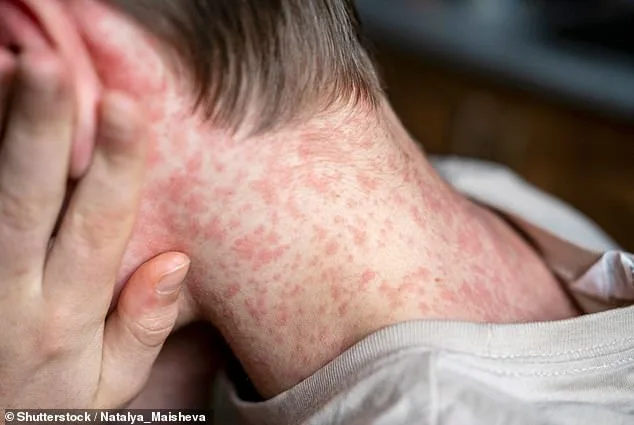 Measles Outbreak at ICE Facility Triggers Quarantine and Emergency Health Measures