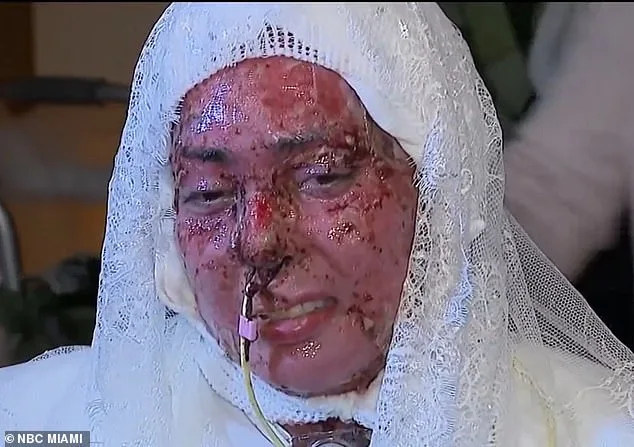 Freak Grill Accident Leaves Woman with Severe Burns, Prompting Unexpected Reflection on Fiancé