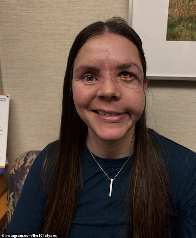 Kenai Mother Survives Bear Attack With Severe Spine And Hip Damage